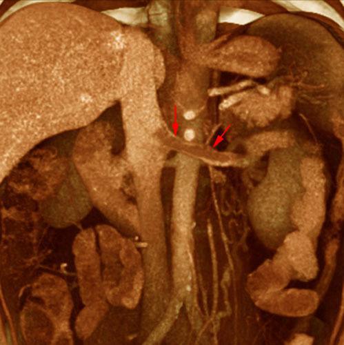 Trombosis de la vena renal izquierda