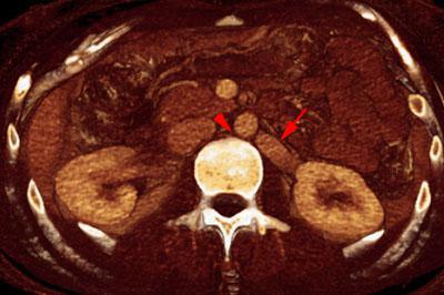 Síndrome del cascanueces retroaórtico