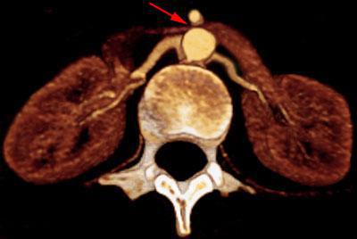 Síndrome del cascanueces 