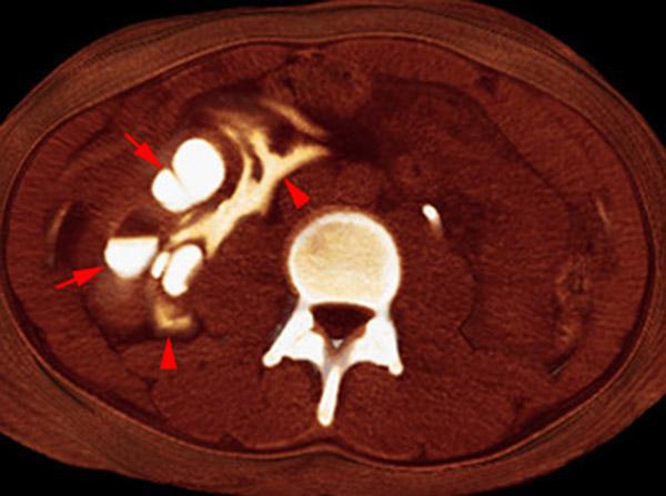 Rotura pielocalicial