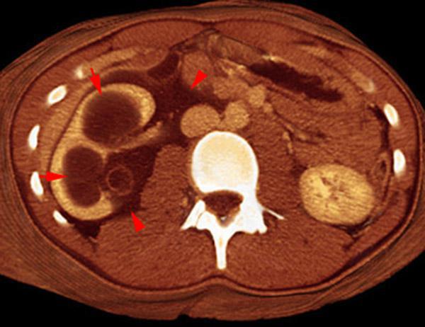 Rotura pielocalicial
