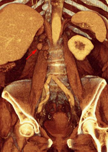 Recidiva adenopática de hipernefroma