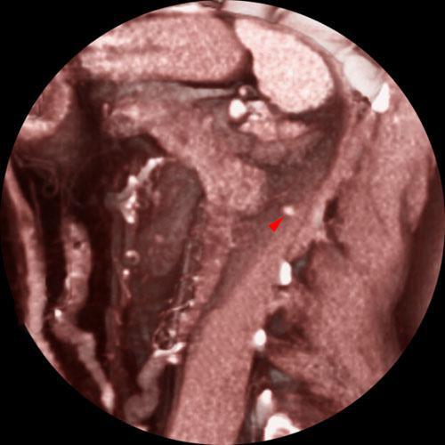 Recidiva local de hipernefroma