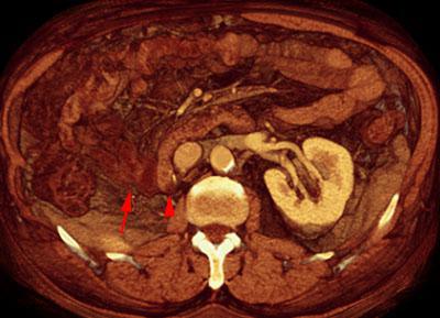 Nefrectomía radical
