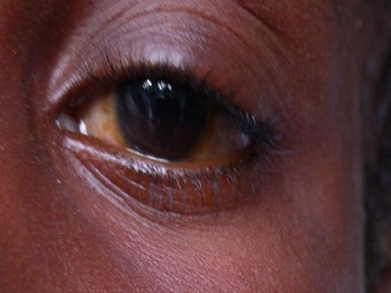 « L’épidémie de conjonctivite peut être un signe de Covid-19 » (Ophtalmologue)
