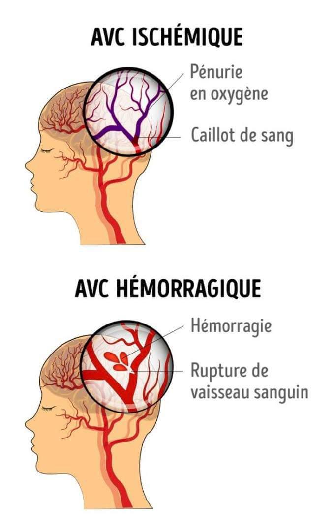 Au service neurologie de Dakar, l'Avc représente la 1ére cause de décès ( ministère)