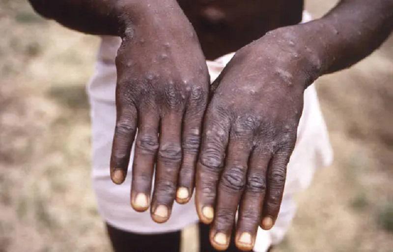 Variole du singe : Bientôt des tests PCR pour la détection du virus