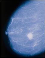 Nouveau traitement Cancer du sein : un espoir augmentant leur espérance de vie