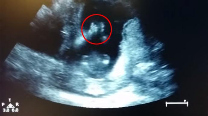 Un bébé applaudit... dans le ventre de sa mère