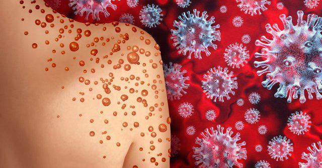 Variant létal du mpox découvert en Suède : premier cas hors d'Afrique