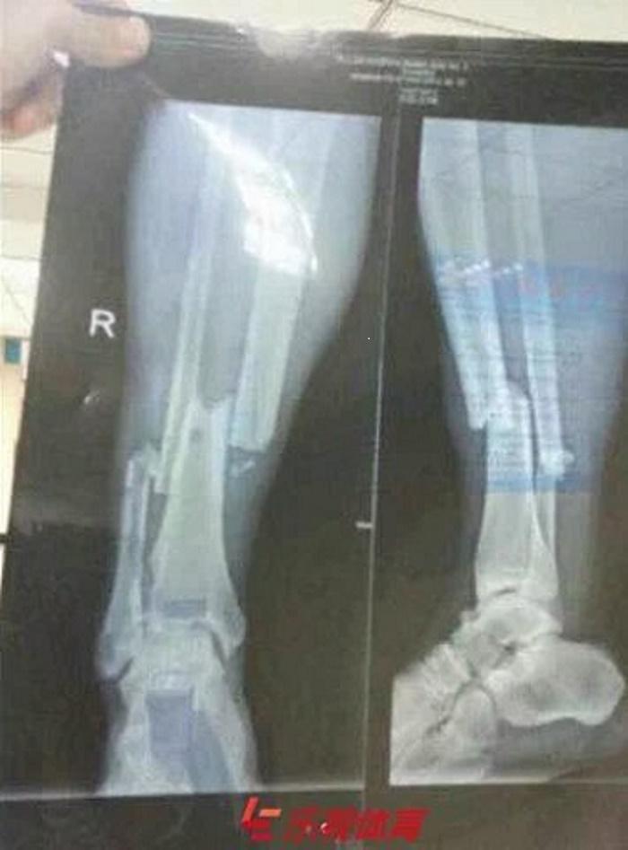 L'horrible radio du tibia de Demba Ba après sa blessure