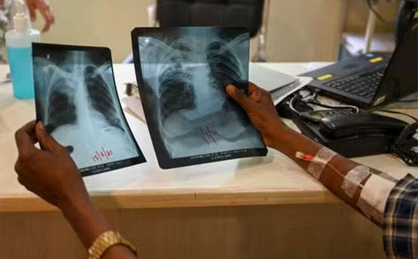 Tuberculose à Kédougou : 163 cas recensés en 2024, un taux de réussite thérapeutique de 68 %