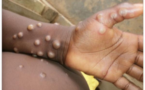 Mpox : guérison du cas importé au Sénégal, le pays ne compte plus aucun cas positif