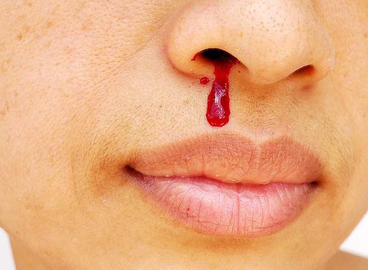 Tuons l'ignorance : épistaxis ou saignement du nez ? est- ce grave ?