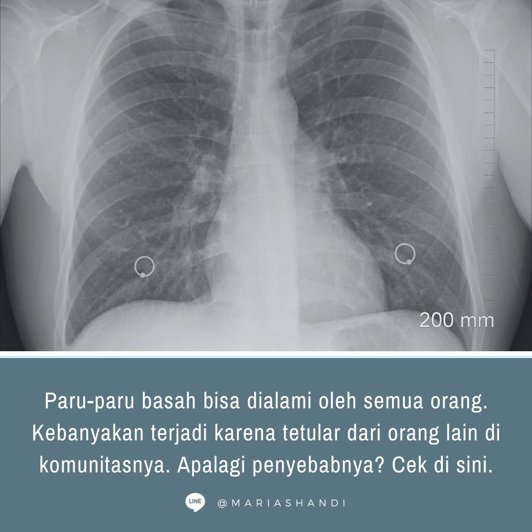 Kebiasaan Penyebab Paru-Paru Basah Kebiasaan Penyebab Paru-Paru Basah