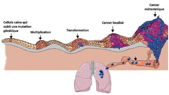 Le cancer, son développement Le cancer, son développement