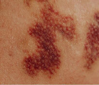 Les effets secondaires de l’immunothérapie Les effets secondaires de l’immunothérapie