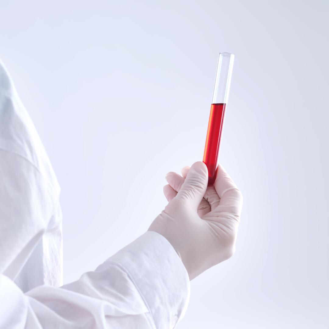 Analisi del profilo, lipidico, glicemia e emoglobina glicata