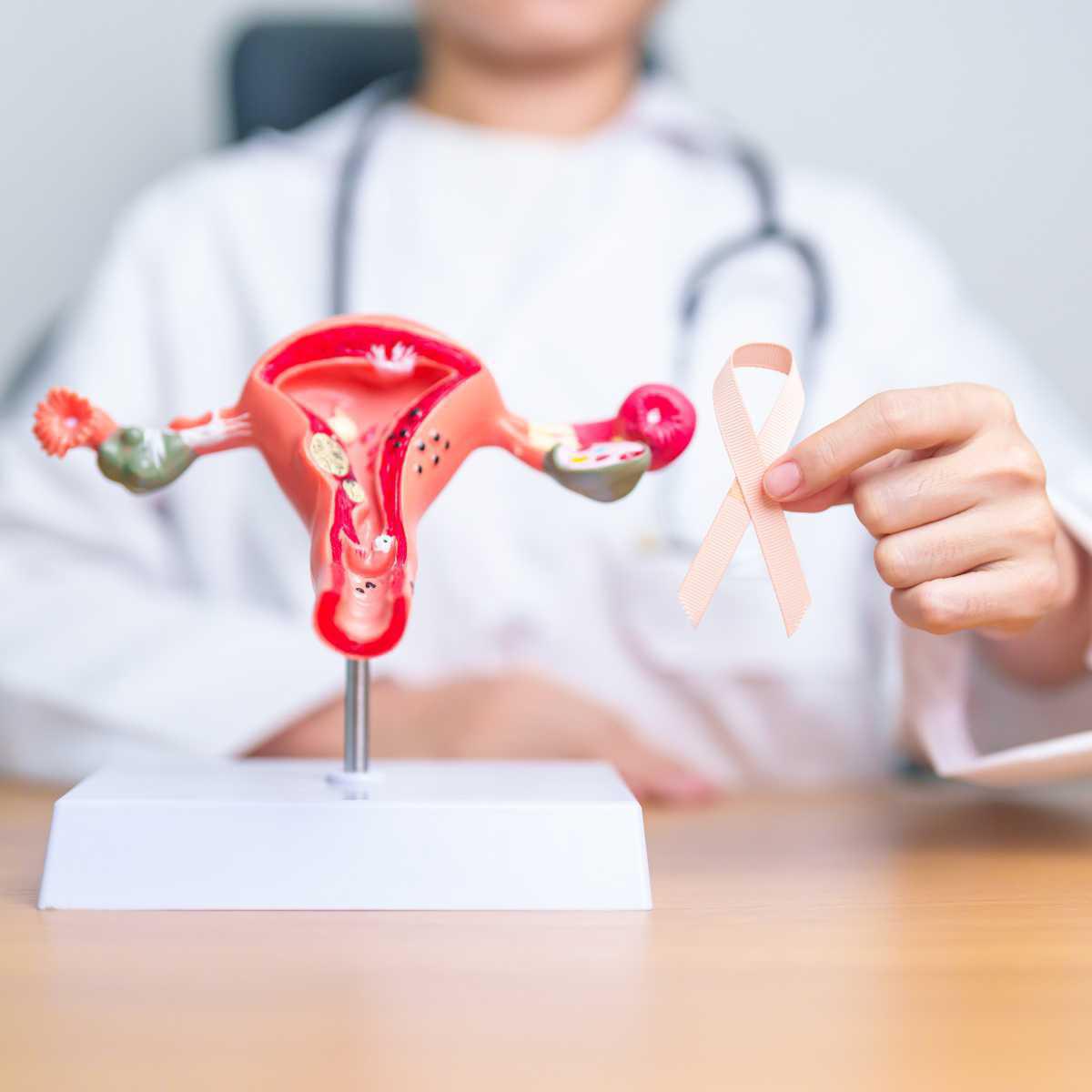 Lien entre endométriose et cancer ovarien : une analyse récente Lien entre endométriose et cancer ovarien : une analyse récente