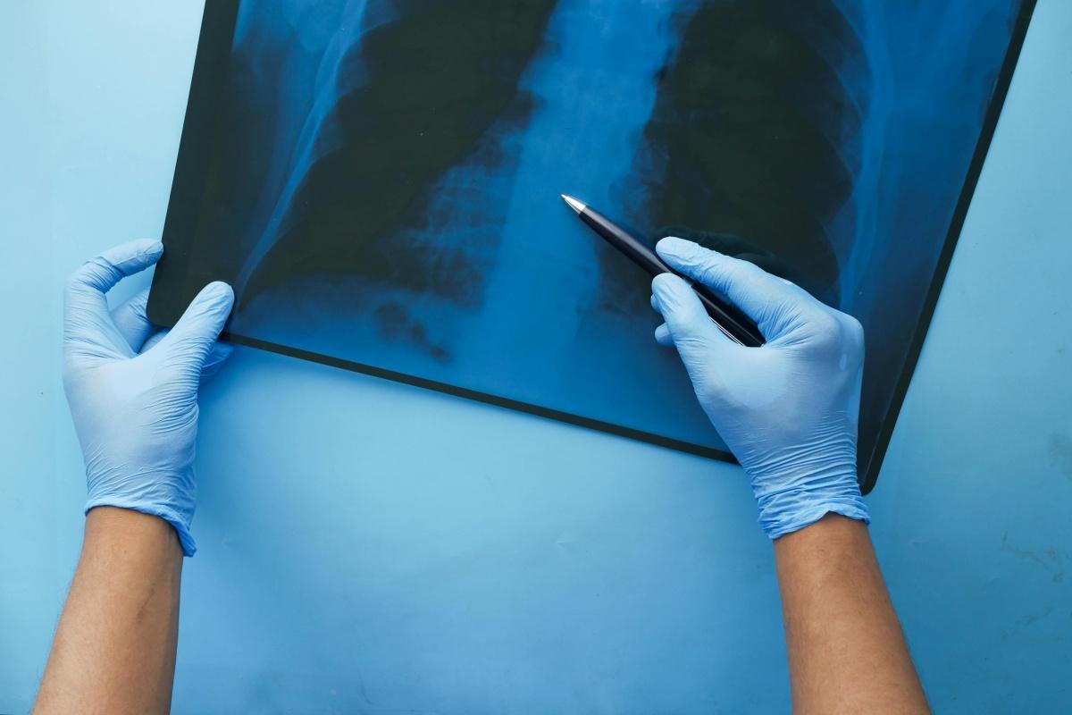 Lancement du projet IMPULSION pour le dépistage du cancer du poumon