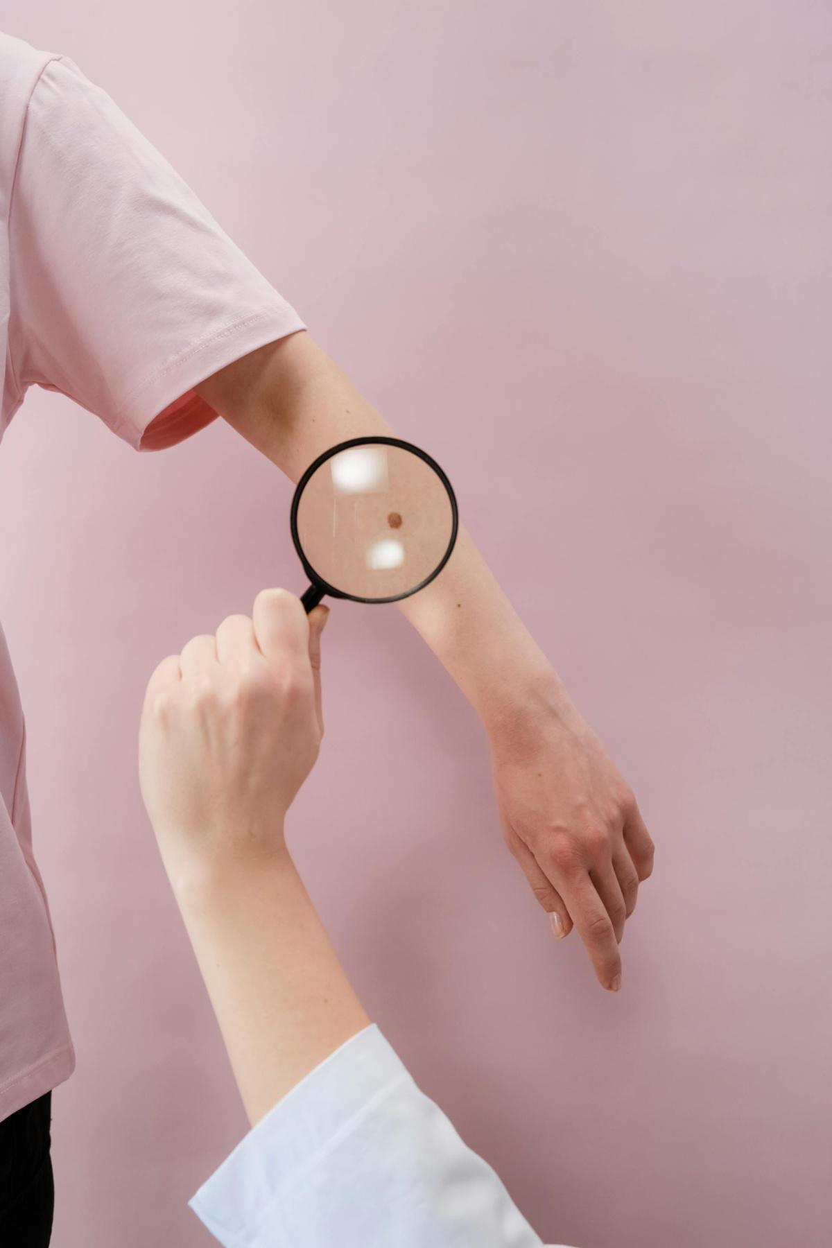AUGMENTATION DES MELANOMES CORRELEE AVEC LE MANQUE DE DERMATOLOGUES