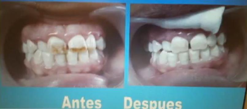 Desmanchamiento (Fluorosis dental)