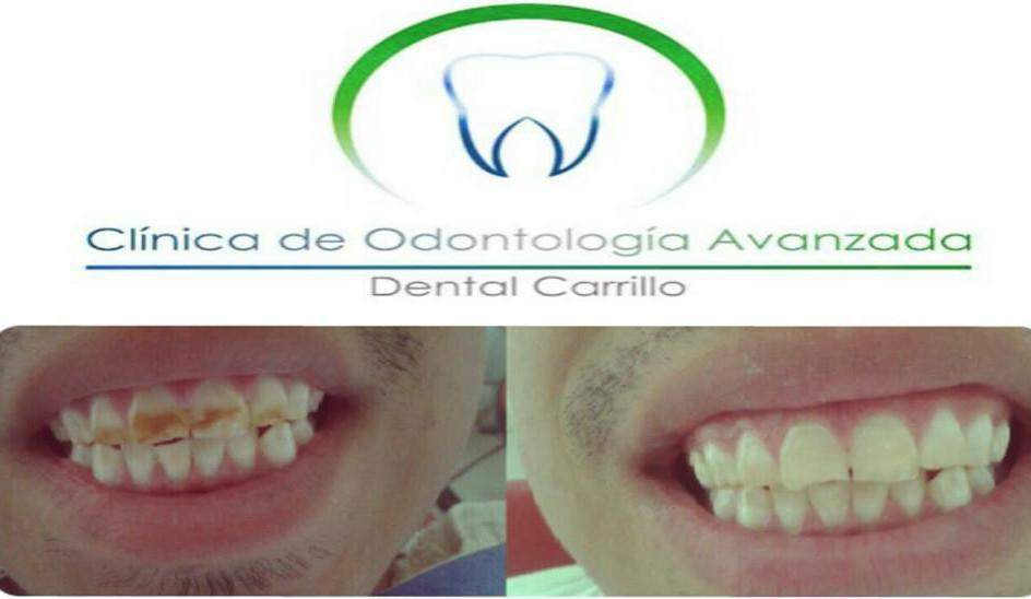 Desmanchamiento (Fluorosis dental)