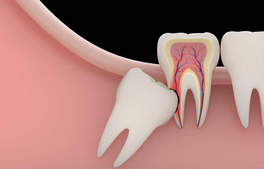  Extracción de tercer molar .