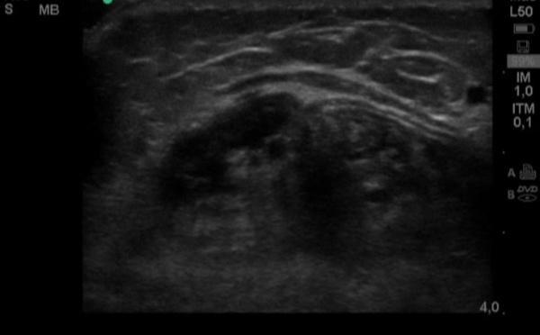 désinsertion myotendineuse du soléaire sur le tendon calcanéen