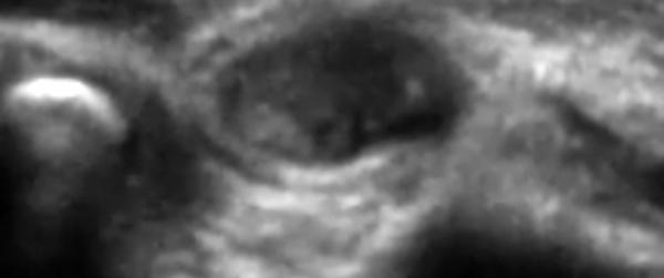 Instabilité du nerf ulnaire au niveau du coude