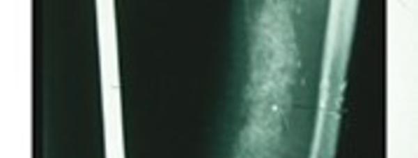 La technique de la membrane induite dans les reconstructions osseuses segmentaires