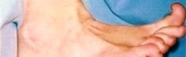Thrombose étendue de la veine saphène externe
