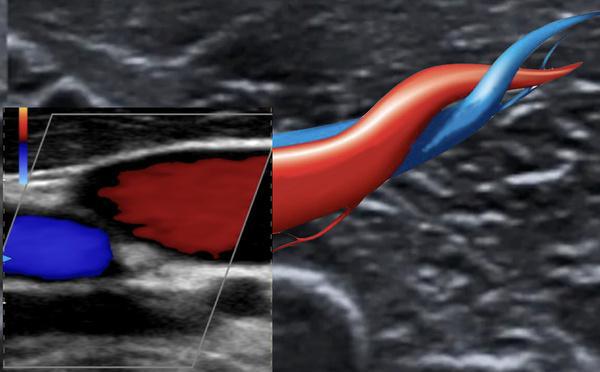 L'essentiel du doppler pour le médecin généraliste