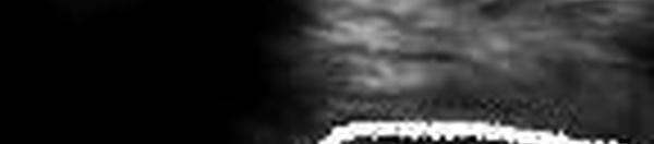 Infiltration Intra-Articulaire du Genou