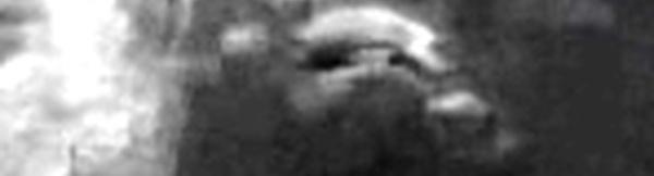 Avulsion osseuse de l' E.I.A.S.