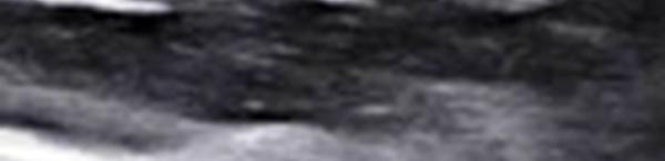 Insertion proximale du chef long du triceps brachial