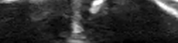 Dysjonction Acromio-Claviculaire