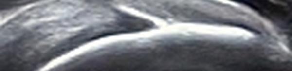 Entésopathie calcifiante du supra-epineux