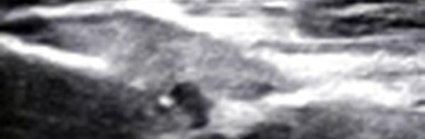 Desinsertion partielle du tendon direct du Rectus Fémori