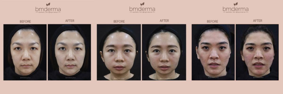 Derma Filler