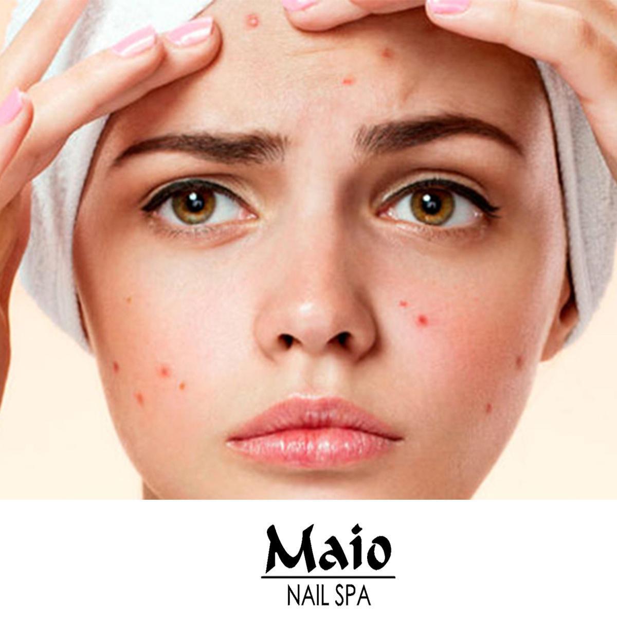 Facial anti acné (Luz pulsada)