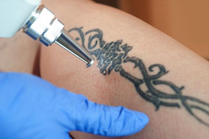 Tattoo Laser
