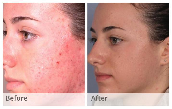 Peeling Acne