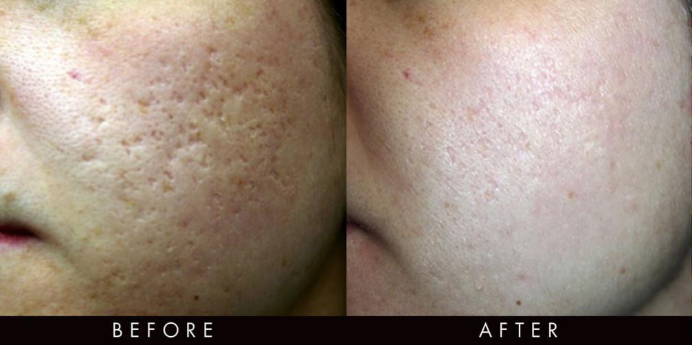Radio Frequency Fractional