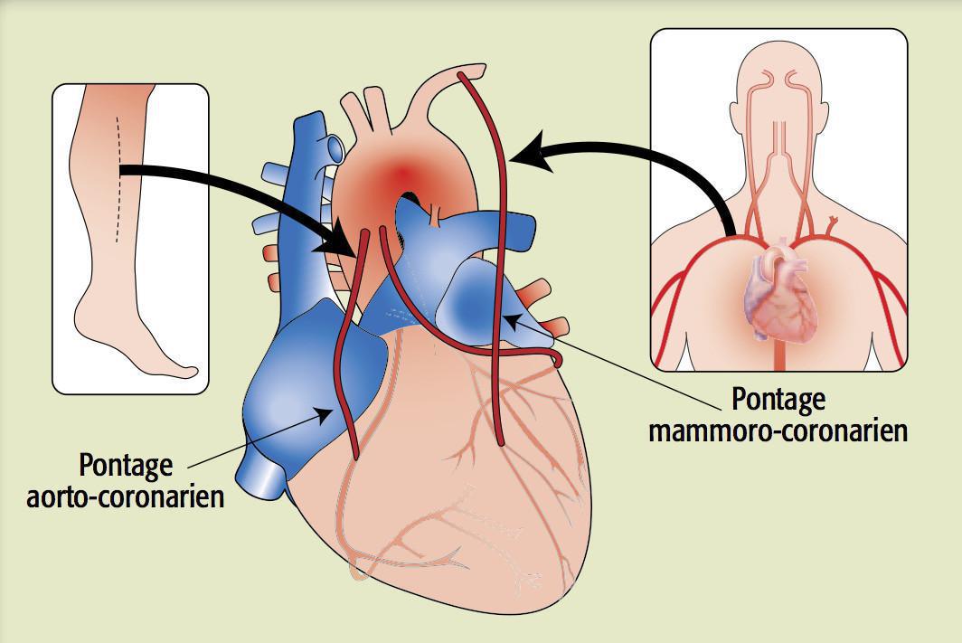  Chirurgie Coronaire (Pontages)