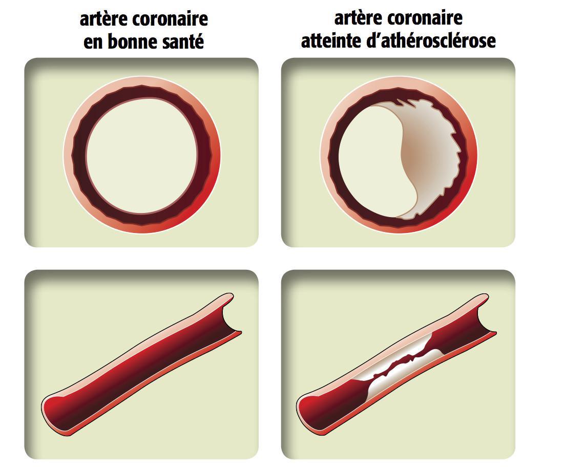  Chirurgie Coronaire (Pontages)