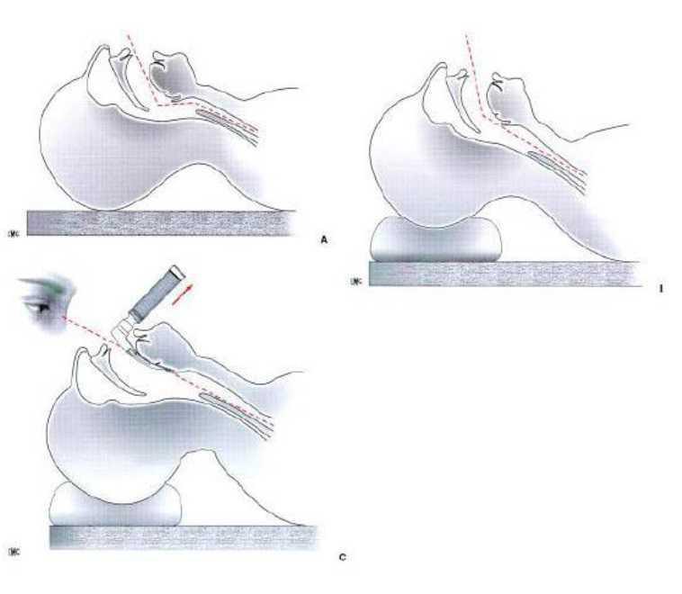 Intubation