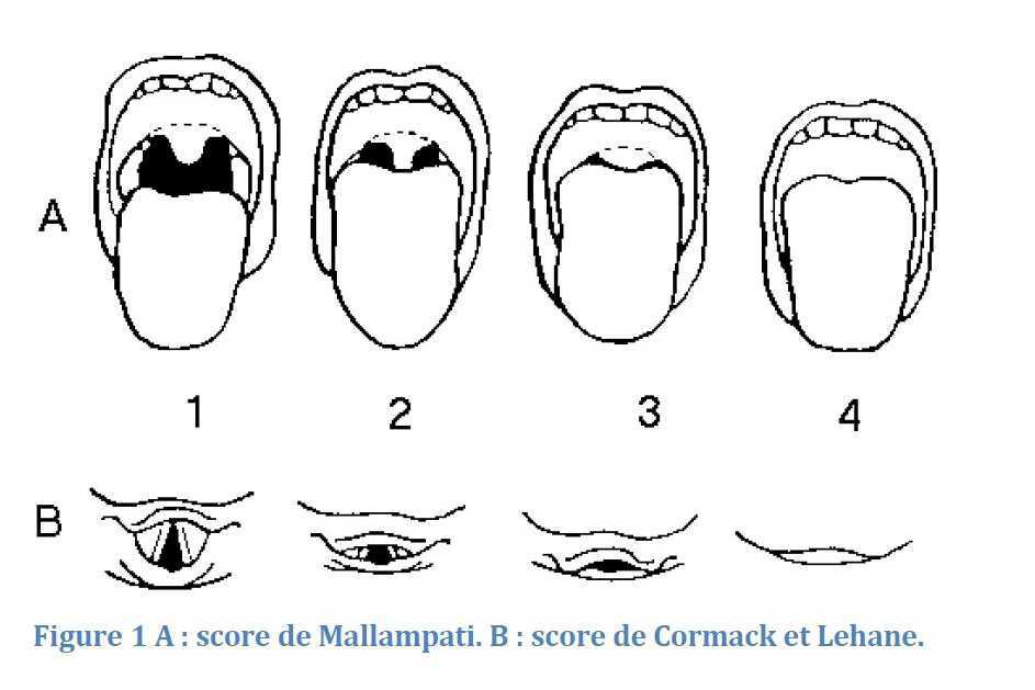 Intubation