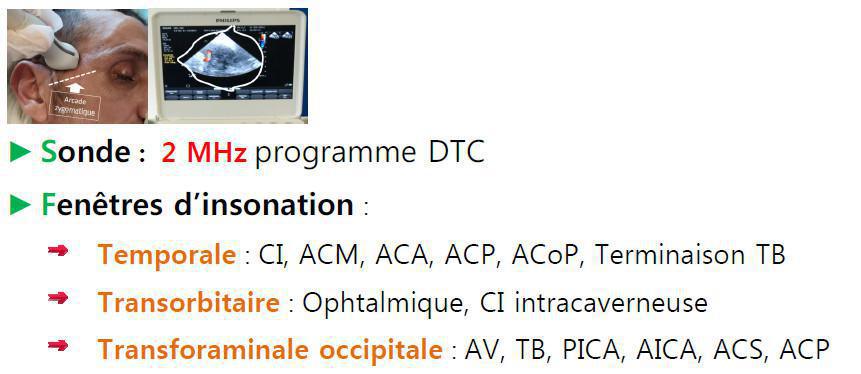DTC (Doppler Transcranien)