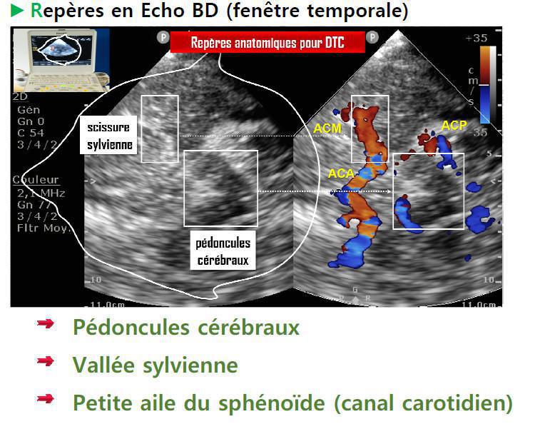 DTC (Doppler Transcranien)